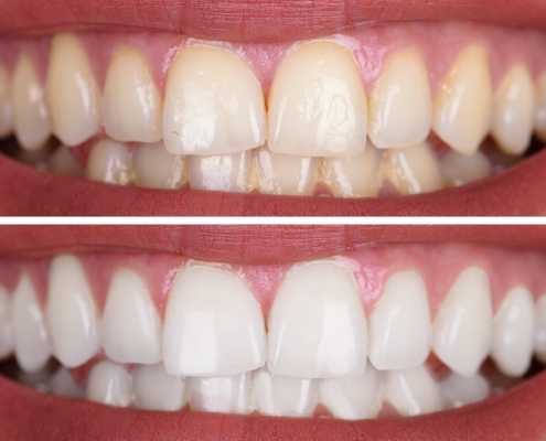 Before and after of teeth whitening treatment at Billingham Dental Practice in Billingham, Stockton-On-Tees