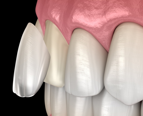 Illustration of Veneer at Billingham Dental Practice in Billingham, Stockton-on-Tees