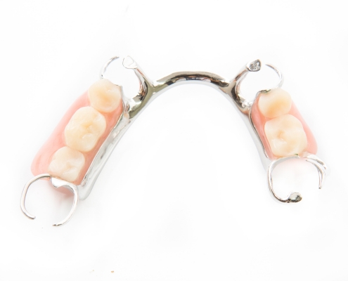 Dental Bridge from Billingham Dental Practice in Billingham, Stockton-On-Tees